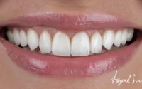 How To Care For Your Veneers