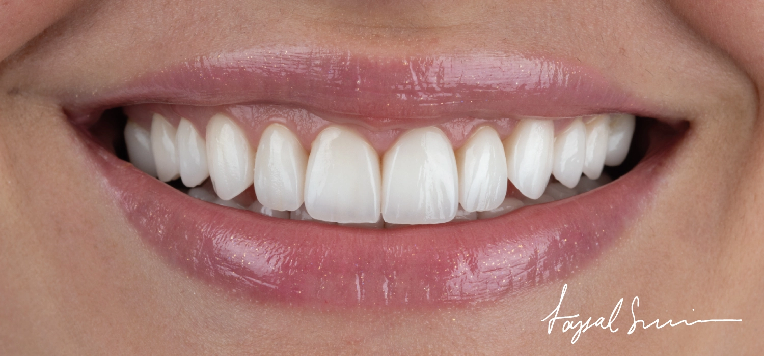 How To Care For Your Veneers